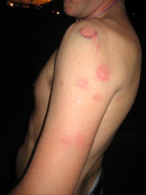 More Paintball injuries