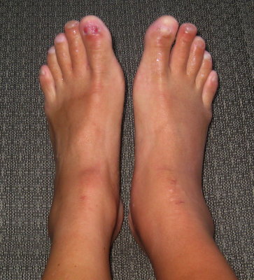 right > left swelling