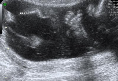 Ultrasound2: Thumbs up!