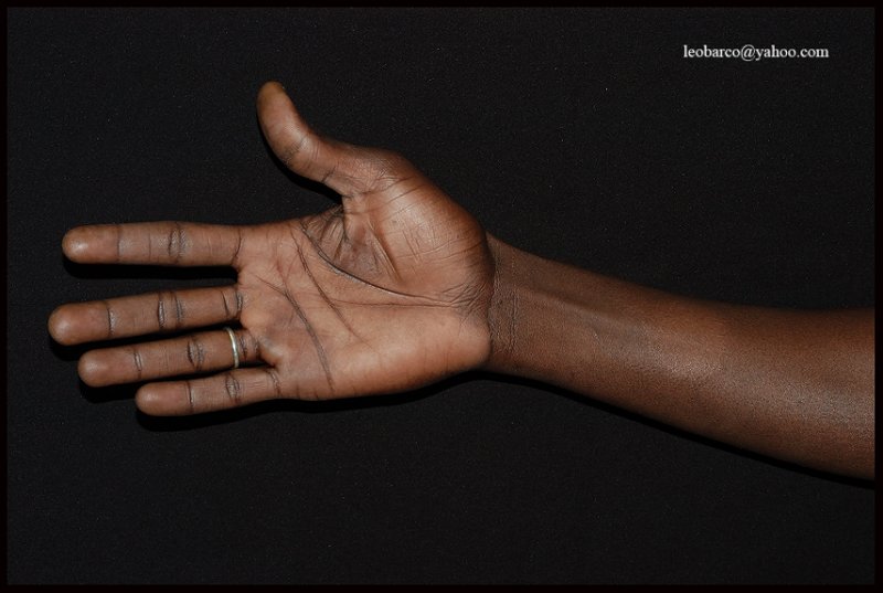 LEPROSY03.jpg