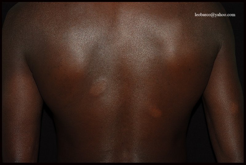 LEPROSY04.jpg