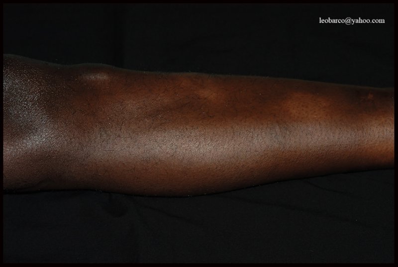 LEPROSY05.jpg