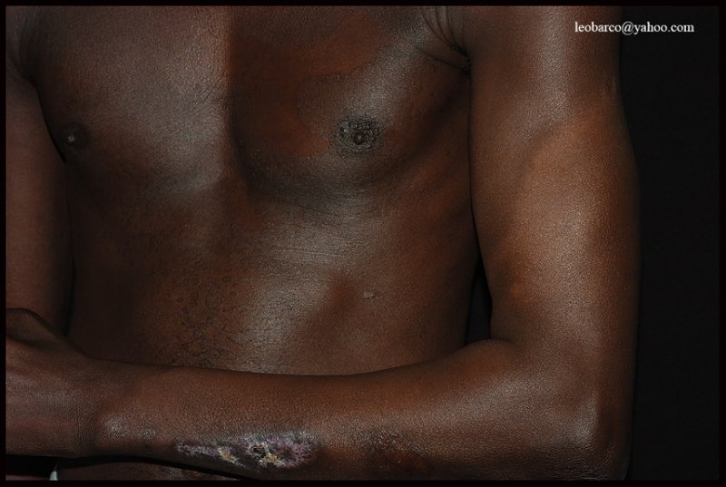 LEPROSY+VERSICOLOR.jpg