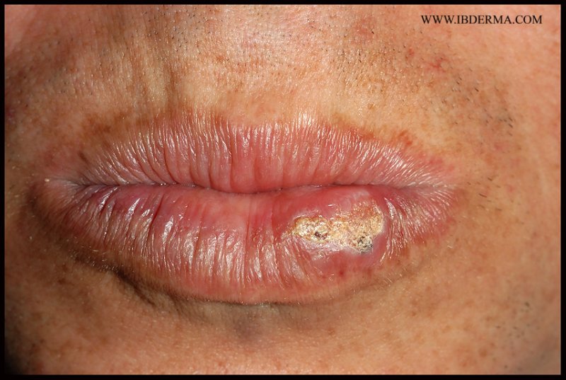 SEVERE_ACTINIC_CHEILITIS.jpg