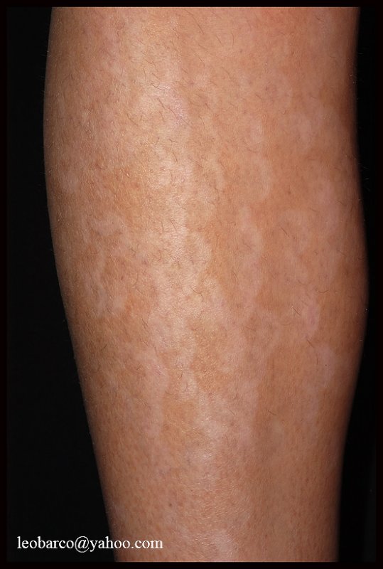 hypomelanosis01.jpg