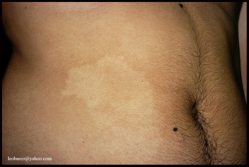 nevus depigmentosus_01.JPG