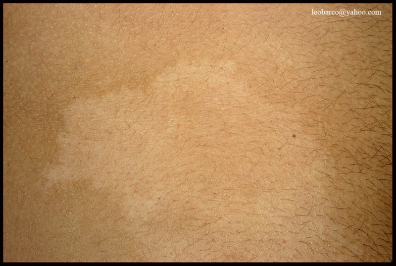 nevus depigmentosus_02.JPG