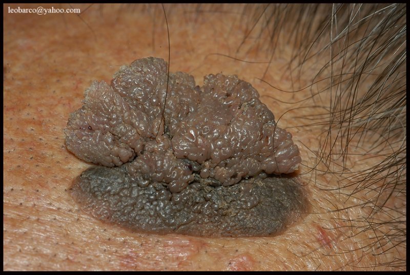 seborrhoeic keratosis_02.JPG