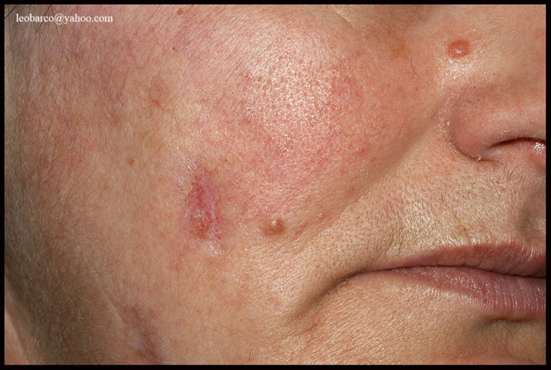 DISCOID LUPUS_01.JPG