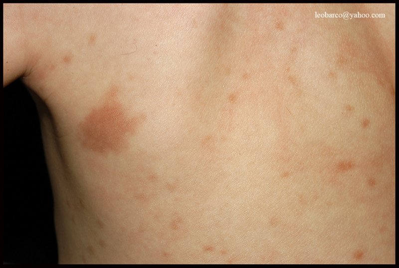 URTICARIA PIGMENTOSA_03.JPG