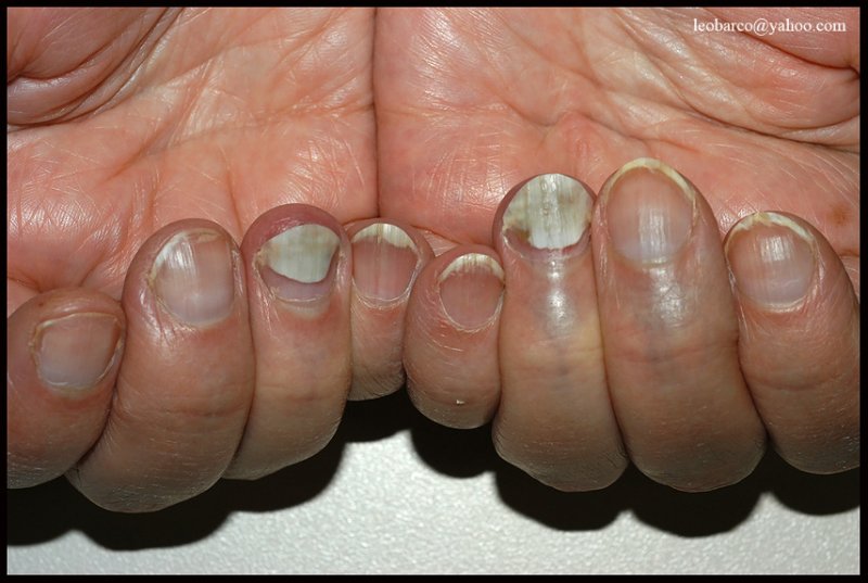 TINEA UNGUIUM.jpg