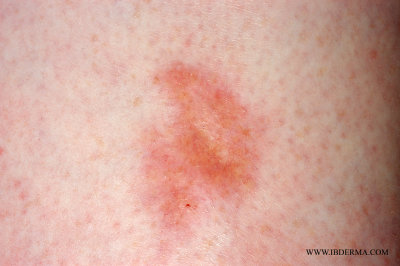 necrobiosis-lipoidica.jpg