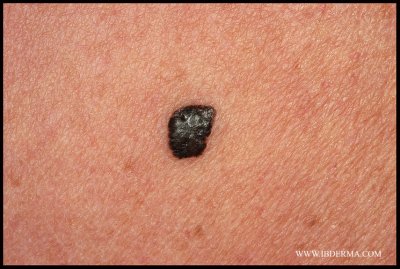 MELANOMA_IN_SITU_02.jpg