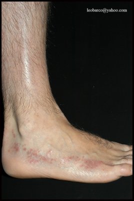 LINEAR LICHEN PLANUS_01.jpg