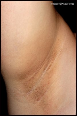 PSEUDOACANTHOSIS NIGRICANS_02.JPG