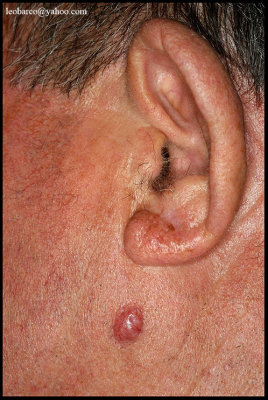 NODULAR BASAL CELL CARCINOMA.JPG