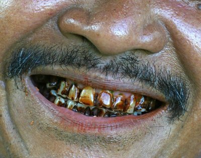 betel teeth