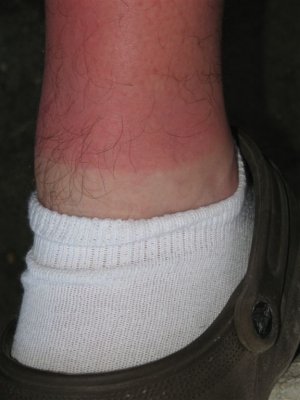 and already sunburnt  (Kevin's leg)