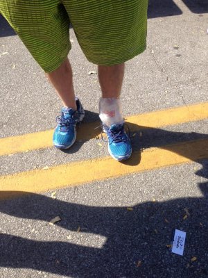 Mike Balsamides' Swollen Ankle.jpg