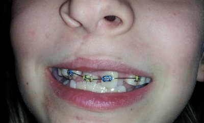 Had them now for six months.I couldn't decide on any one color. Dr Galkin says it will be a long road ahead now. Maybe up to four years of metal in my mouth, and another ten with a retainer.