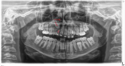 The top arrow shows a mutant tooth living in the palate. It will have to be surgically removed. The next arrow shows a tooth with no place to go. It will have to be chained and towed to home port.