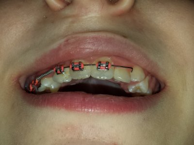 I discovered half my daughters braces are missing on the right side. She has no idea where they could of gone off too....