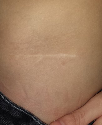 This is the scar left behind after the bone graft back in 2012. Almost faded away.