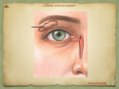 Lacrimal Outflow Surgery.007.jpeg