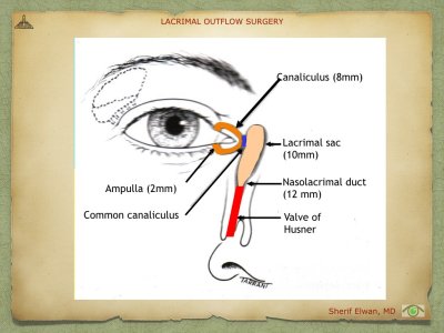 Lacrimal Outflow Surgery.008.jpeg