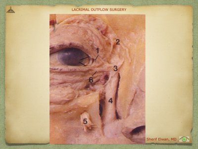 Lacrimal Outflow Surgery.011.jpeg