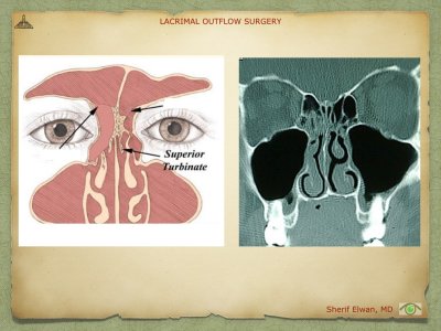 Lacrimal Outflow Surgery.016.jpeg