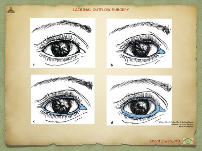 Lacrimal Outflow Surgery.027.jpeg
