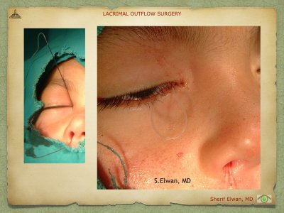 Lacrimal Outflow Surgery.031.jpeg