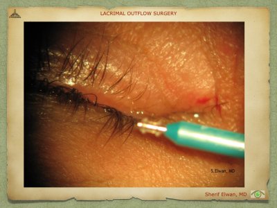 Lacrimal Outflow Surgery.035.jpeg