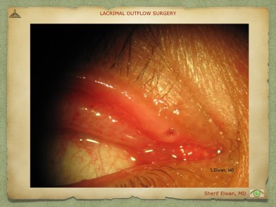 Lacrimal Outflow Surgery.036.jpeg