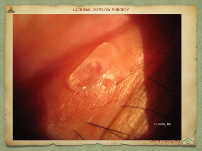Lacrimal Outflow Surgery.037.jpeg