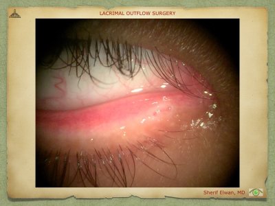 Lacrimal Outflow Surgery.039.jpeg