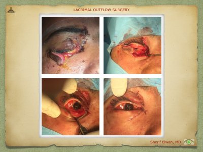 Lacrimal Outflow Surgery.042.jpeg