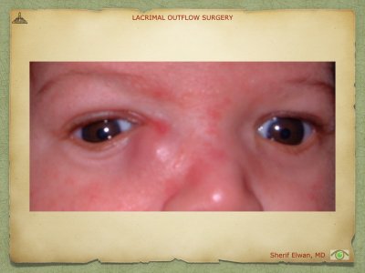 Lacrimal Outflow Surgery.046.jpeg