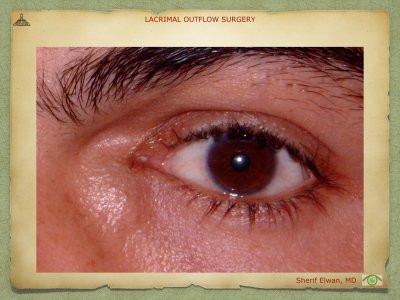 Lacrimal Outflow Surgery.047.jpeg