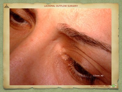 Lacrimal Outflow Surgery.048.jpeg