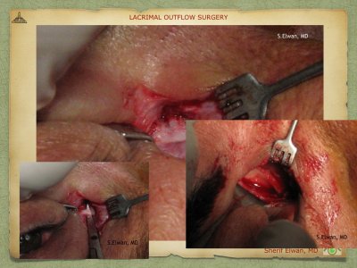 Lacrimal Outflow Surgery.049.jpeg
