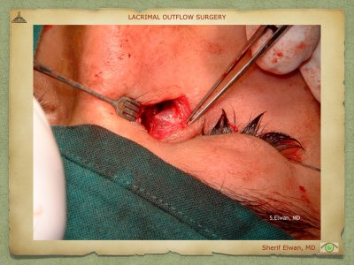 Lacrimal Outflow Surgery.050.jpeg