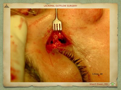Lacrimal Outflow Surgery.051.jpeg
