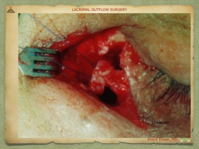 Lacrimal Outflow Surgery.052.jpeg