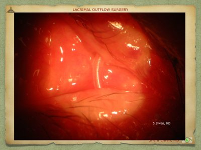 Lacrimal Outflow Surgery.053.jpeg