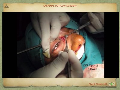 Lacrimal Outflow Surgery.054.jpeg