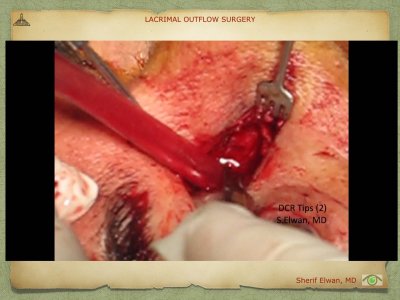 Lacrimal Outflow Surgery.055.jpeg