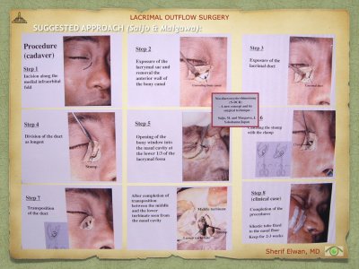 Lacrimal Outflow Surgery.059.jpeg