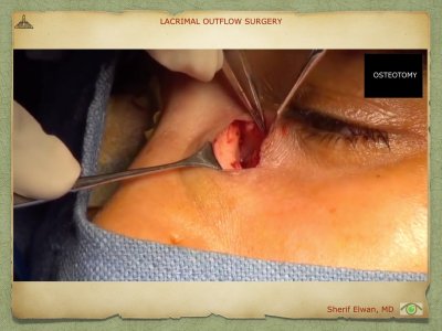 Lacrimal Outflow Surgery.062.jpeg